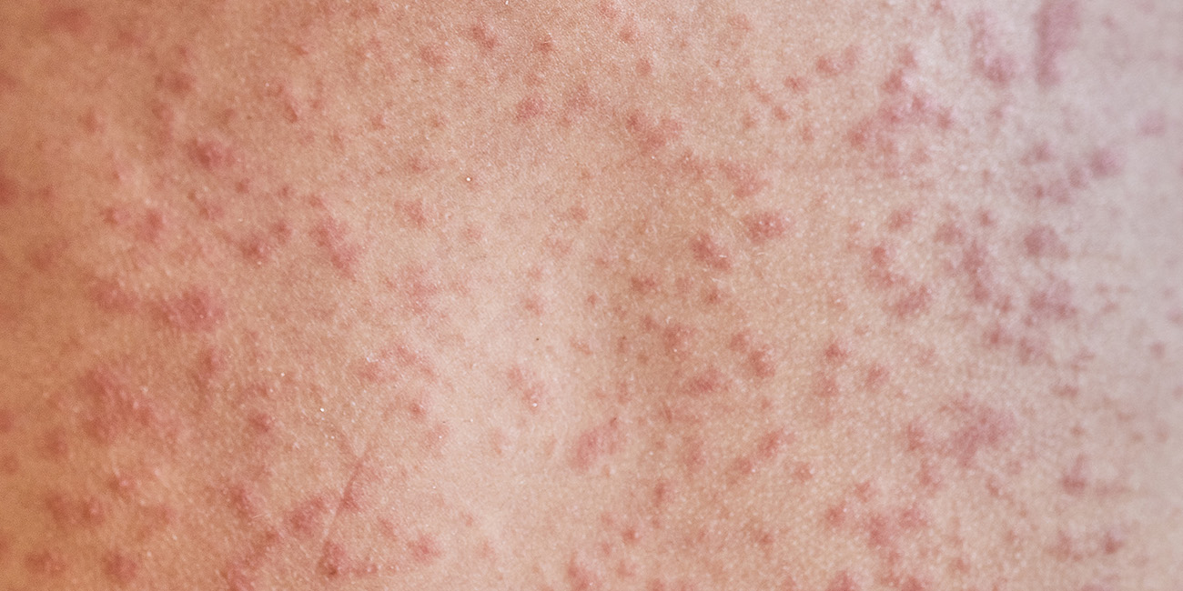 Lymphoma Rash: Symptoms and Next Steps