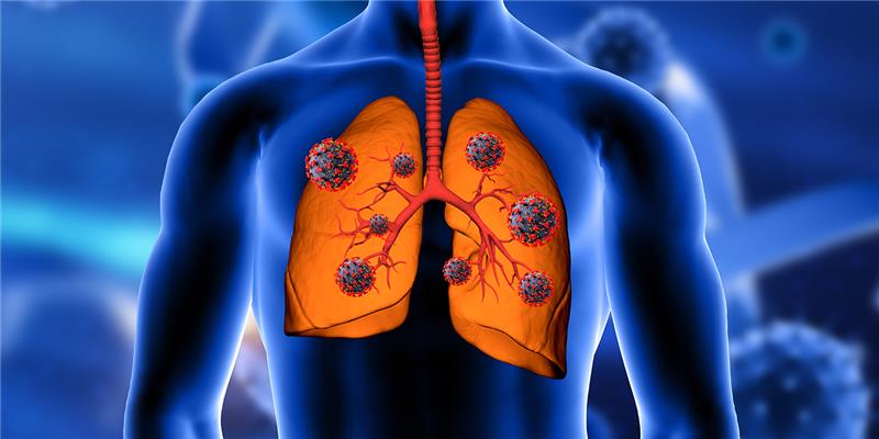 Nodules in Lungs: Causes and Treatment