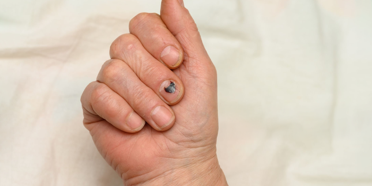 Subungual Melanoma (Cancer in Fingernails)