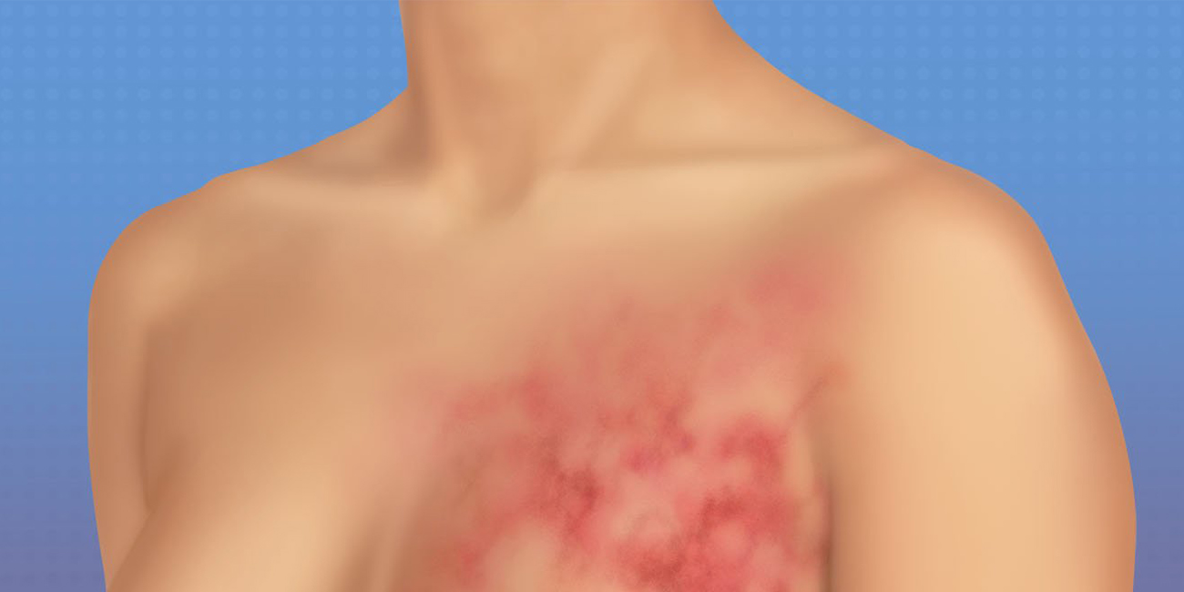 Breast Cancer Rash: Causes and Care