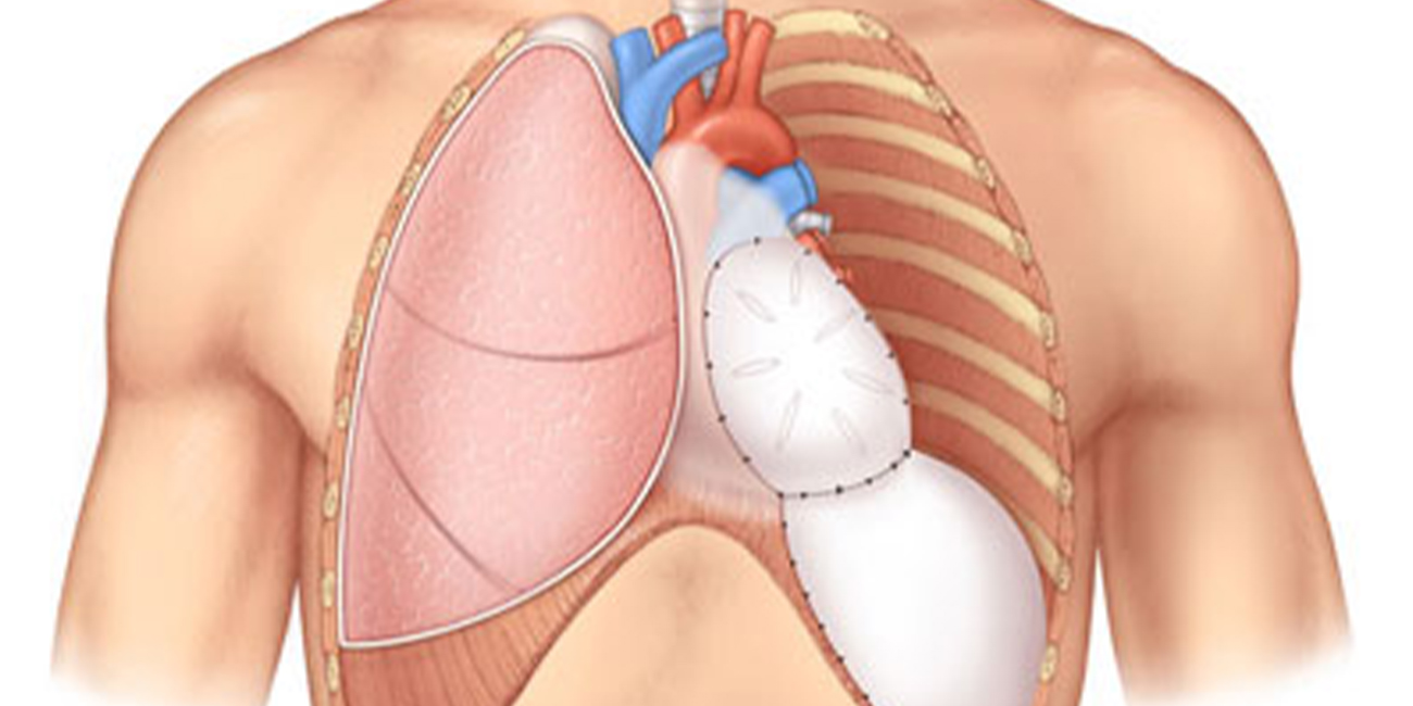 What Is a Pneumonectomy?