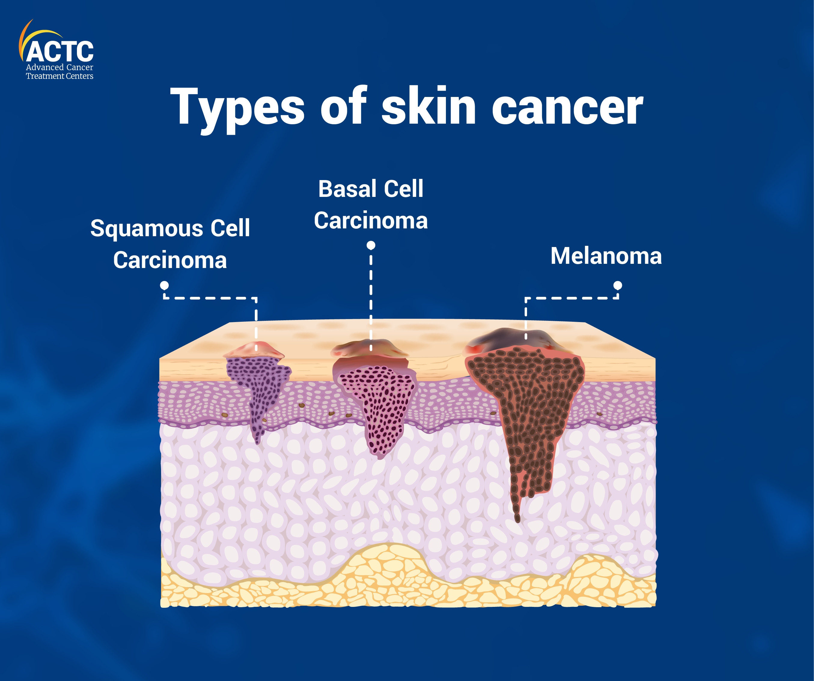 Types of Skin Cancer