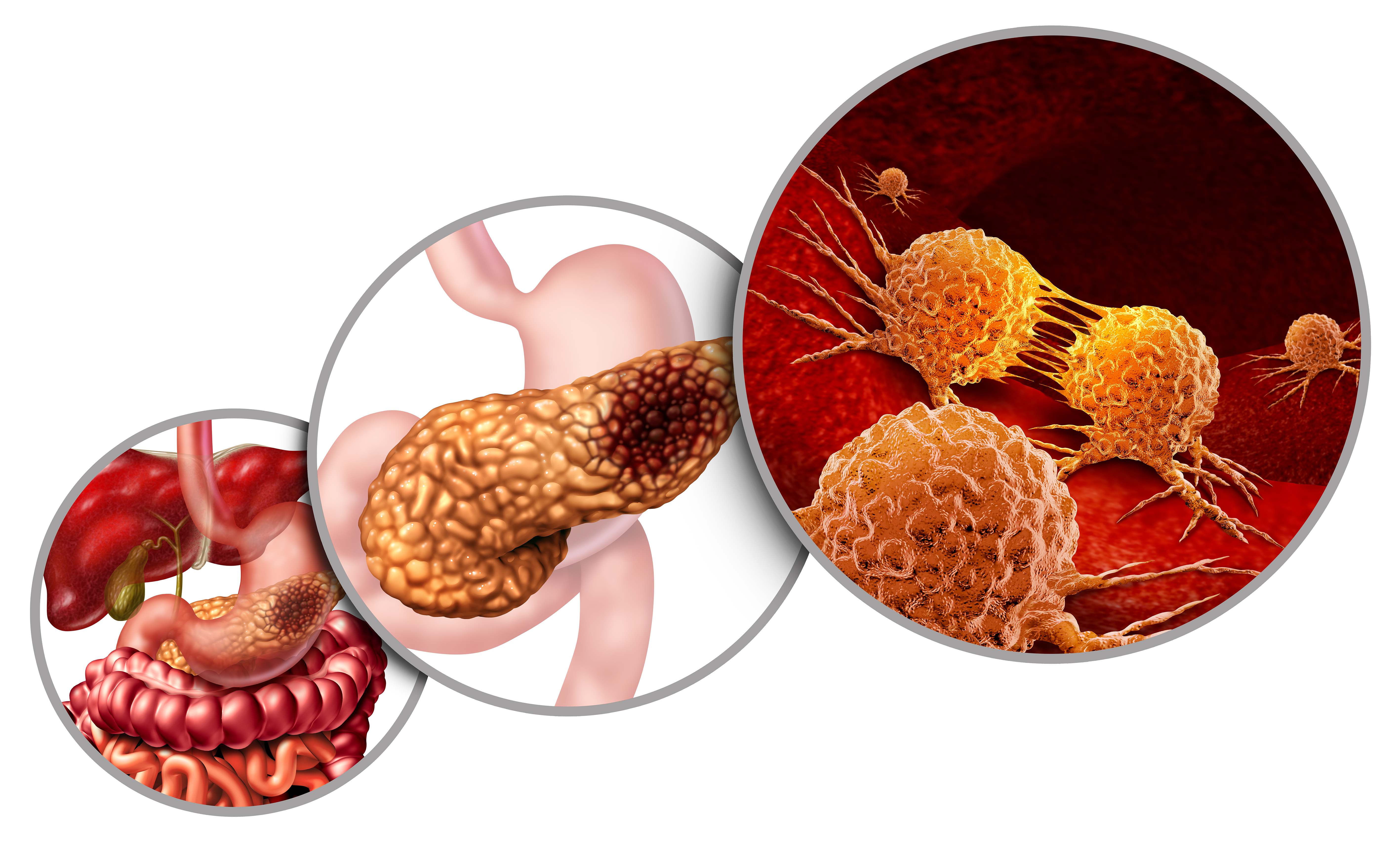 Pancreatic Cancer Stages And Outcomes