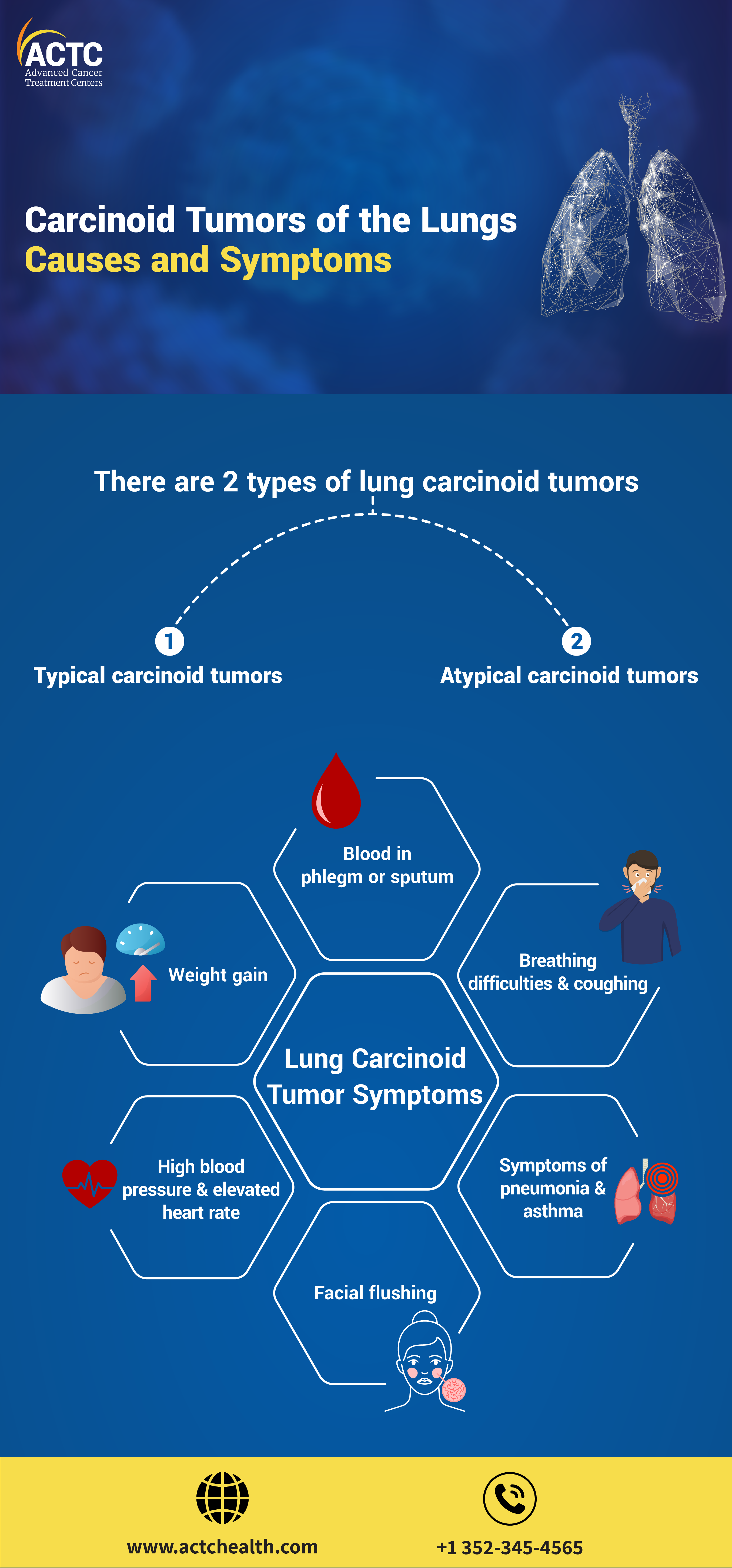 Treatment options for lung carcinoid tumor