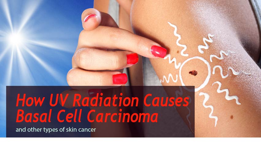 How UV Radiation Causes Basal Cell Carcinoma and other types of skin cancer